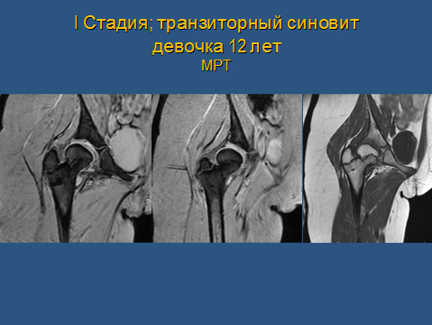 Остеохондропатия головки бедренной кости (болезнь легг-кальве-петерса)