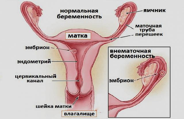 Внематочная беременность - симптомы и первые признаки внематочной беременности у женщин |
эко-блог