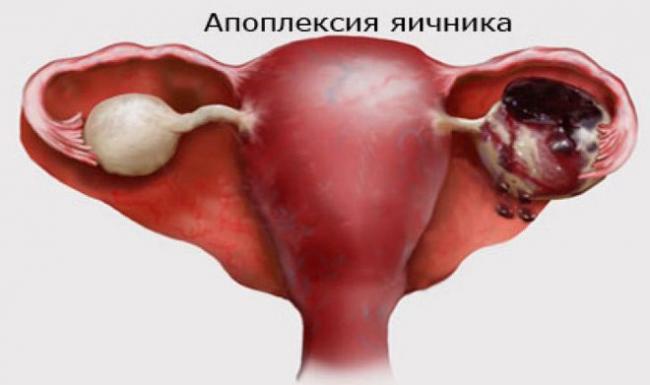 Признаки и лечение кисты яичника