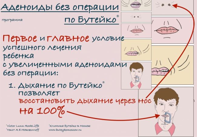 Самые эффективные средства для лечения аденоидов у детей без операции