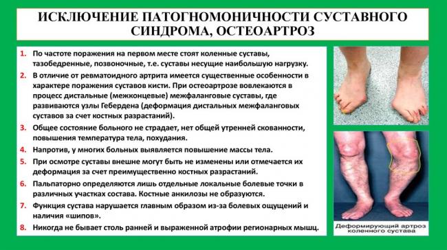 Остеоартроз: симптомы, лечение, причины, препараты