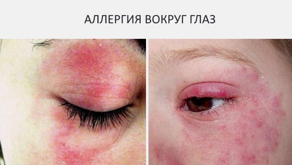 Красное пятно под глазом шелушится
