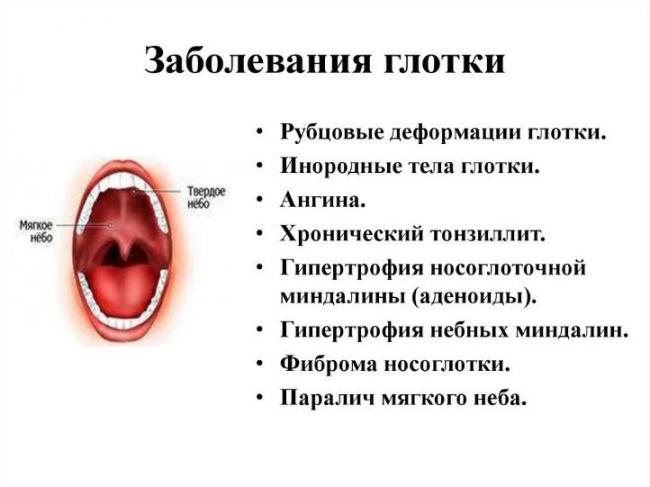 Болезни горла и гортани – причины, симптомы, лечение и профилактика