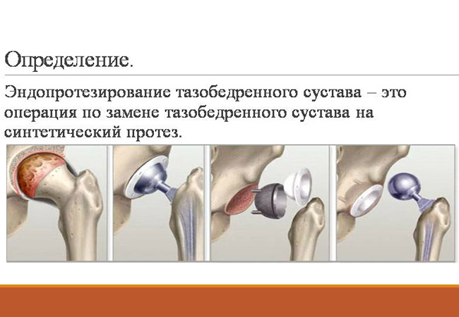 Чем опасно эндопротезирование суставов - нолтрекс. препарат для лечения остеоартроза, артроза, артрита, остеоартрита и других болезней суставов