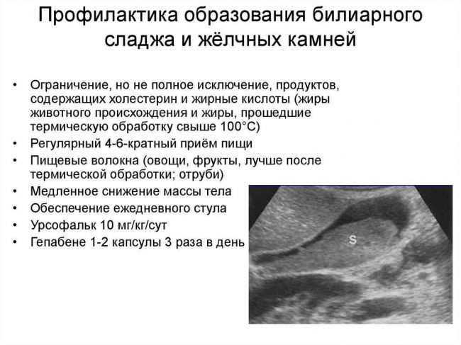 Сладж в желчном пузыре лечение