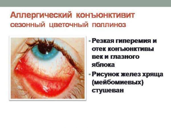Как быстро вылечить конъюнктивит у детей в домашних условиях аптечные капли и народные средства