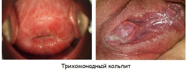 Симптомы и лечение кольпита (неспецифического вагинита)