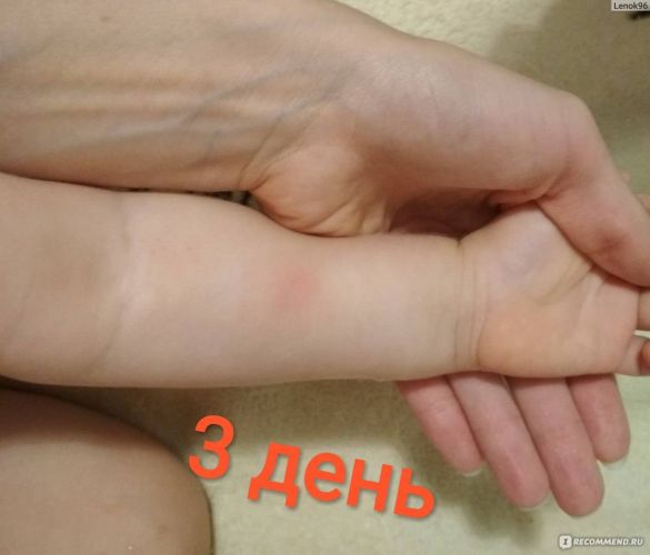 Что такое манту — все ответы о туберкулиновой пробе