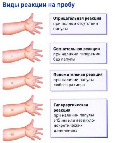 Таблица размеров пробы манту у ребенка и факторы влияющие на результат