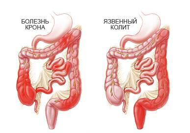 Диета при гастрите панкреатите колите