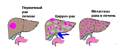 Гемангиома печени