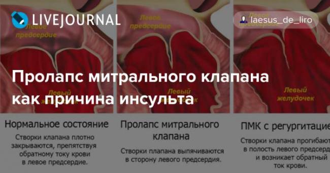 Пролапс что это