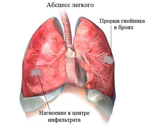 Мокрота с кровью при кашле по утрам