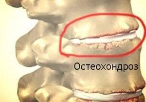Карбокситерапия при остеохондрозе шейного отдела отзывы
