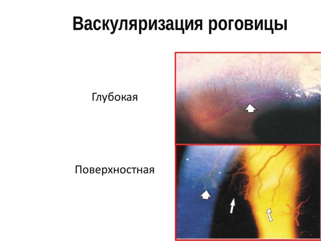 Кератит
