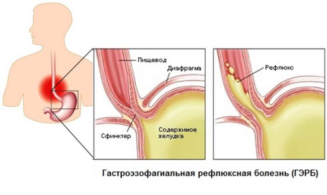 Гастроэзофагеальная рефлюксная болезнь желудка (гэрб): классификация, симптомы, лечение и питание при заболевании