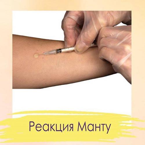 Реакция манту у ребенка
