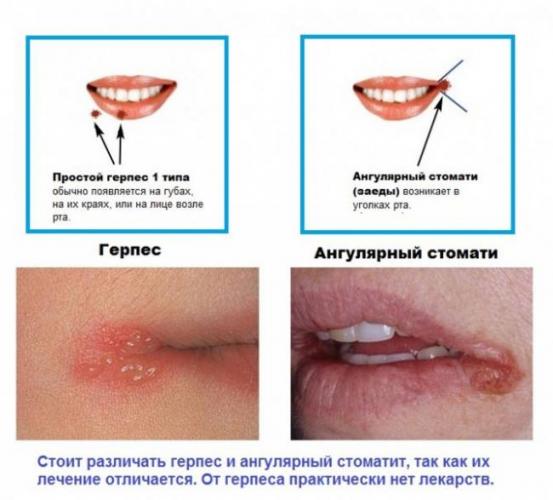 Лечение заедов в уголках губ: лекарства, мази и кремы, витамины и народные средства