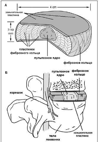 Симптомы и лечение грыжи позвоночника