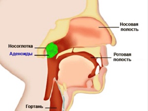 Аденоиды у детей – всегда ли их нужно удалять?