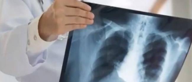 Туберкулез: симптомы и первые признаки в начальной стадии