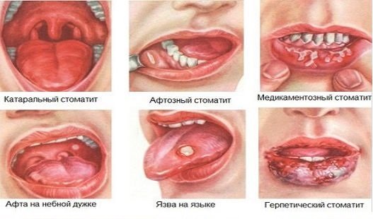 Стрептоцид (сульфаниламид) - описание препарата