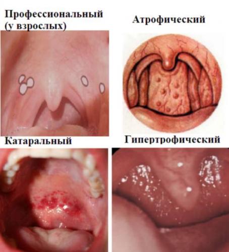 Самые распространённые болезни горла: симптомы заболеваний и лечение