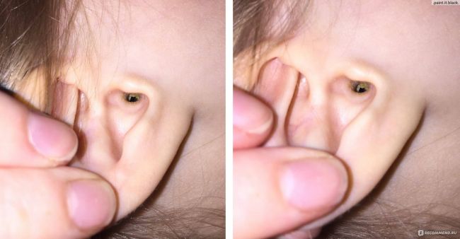 Ушная пробка признаки. бывает ли боль в ухе при серной пробке? удаление ушной пробки в домашних условиях.