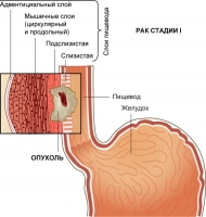 Меню при раке пищевода и желудка