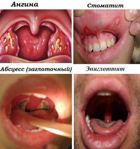 Чем лечить больное горло у ребенка 5 лет