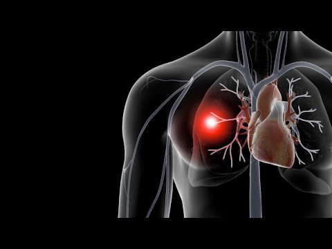 Артериальный тромбоз: лечение, симптомы, причины