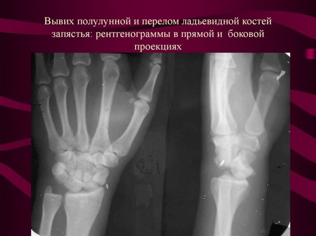 Травмы (переломы) лучевой кости