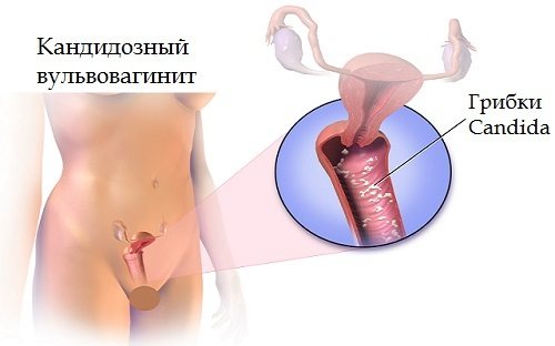 Вульвит у женщин и девочек, острая и хроническая формы - лечение, симптомы и причины - docdoc.ru