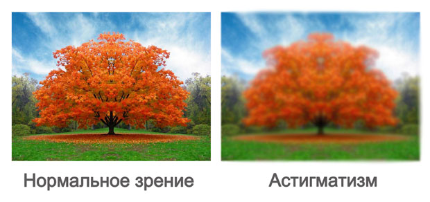 Миопический астигматизм – чем простая близорукость отличается от сложной