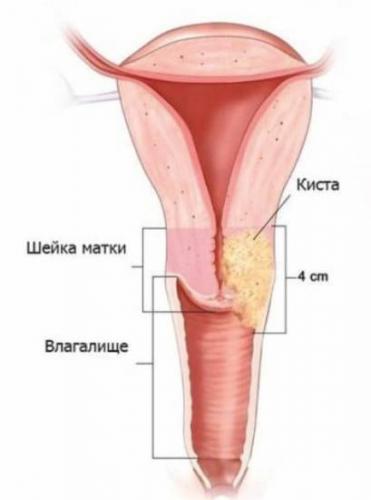 Что такое наботова киста шейки матки и как ее лечить