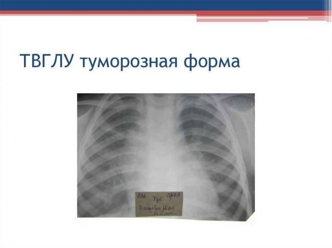 Туберкулез лимфоузлов: симптомы и первые признаки, диагностика, лечение