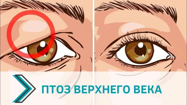 Птоз верхнего века — причины возникновения у взрослых