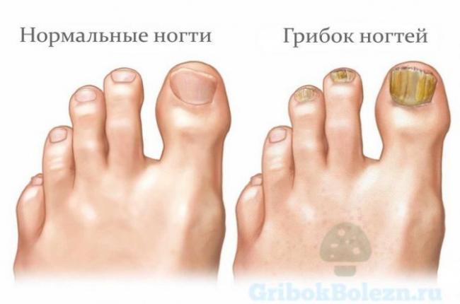 Грибок на руках: причины, симптомы, как и чем лечить