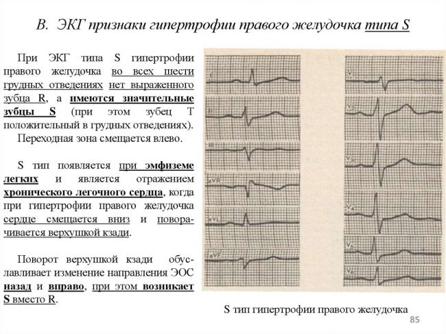Гипертрофия правого желудочка — причины и лечение