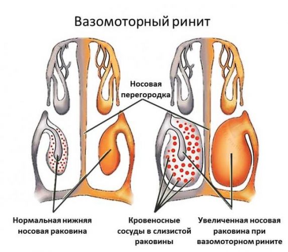 Вазомоторный ринит: лечение в домашних условиях народными средствами