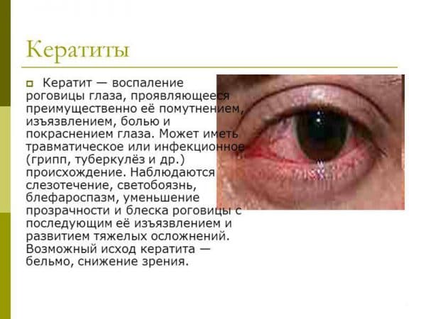 Бельмо (лейкома) на глазу