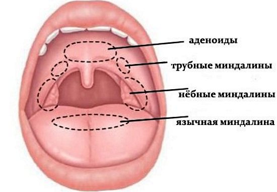 Тонзиллит камень: удаление пробок из миндалин, как убрать, чем лечить