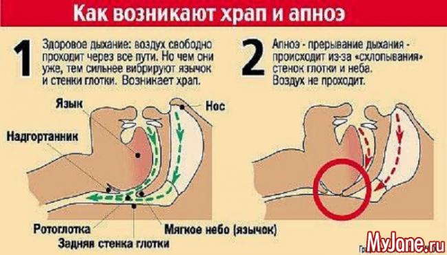 Обструктивное апноэ сна: симптомы и лечение