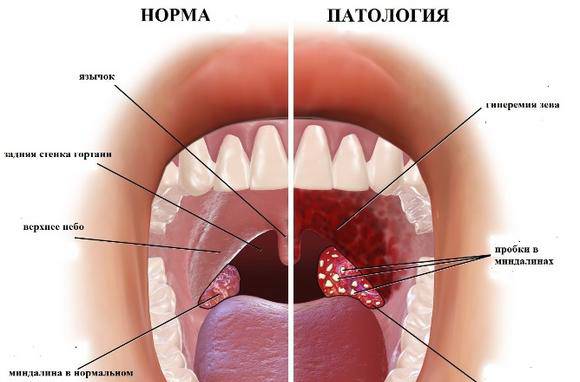 Гнойные и кавернозные пробки в горле: причины образования, методы лечения и профилактики
