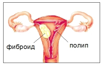 Децидуальный полип: симптомы, диагностика, лечение.