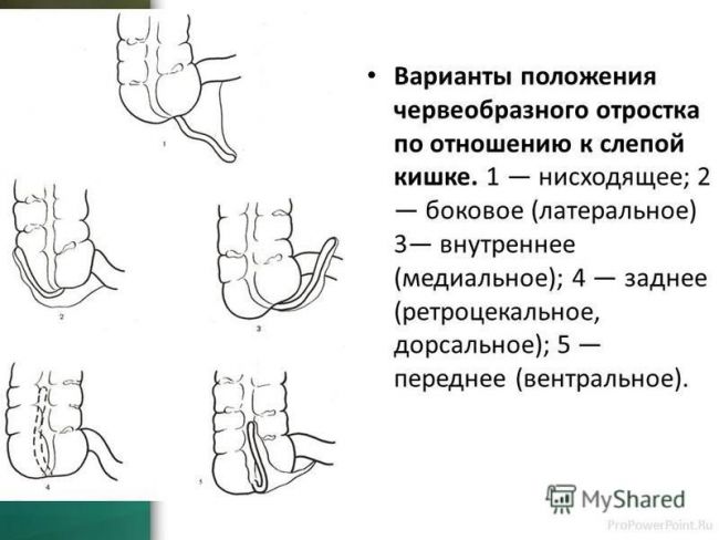 Анатомия человека: слепая кишка. червеобразный отросток ( апендикс, аппендикс ). строение, стенки червеобразного отростка ( апендикса, аппендикса ). строение, стенки слепой кишки.