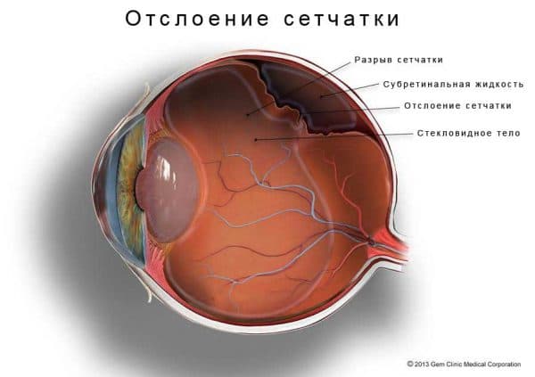 Деструкция стекловидного тела