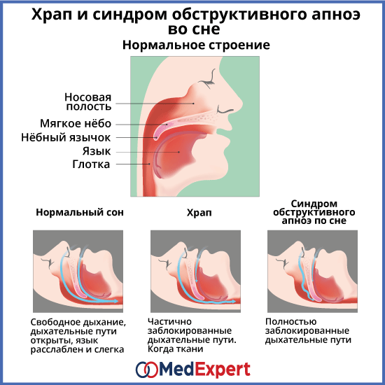 Знакомимся с синдромом обструктивного апноэ сна