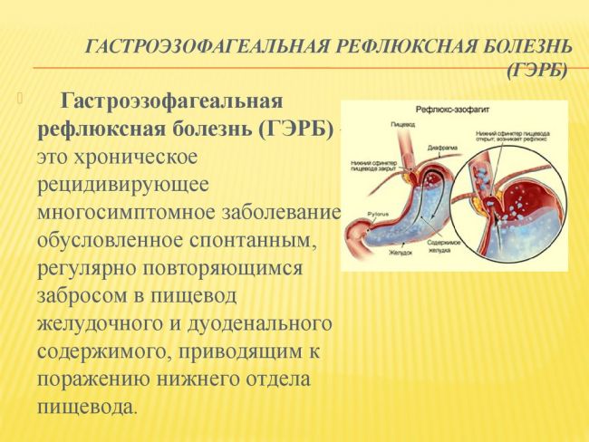 Что такое гастроэзофагеальный рефлюкс с эзофагитом, гэрб — описание, симптомы и лечение