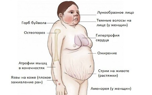 Болезнь иценко-кушинга